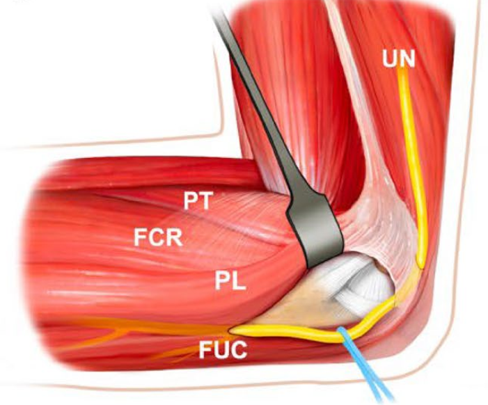 冠突骨折的解剖特点、分型与6种内侧手术入路