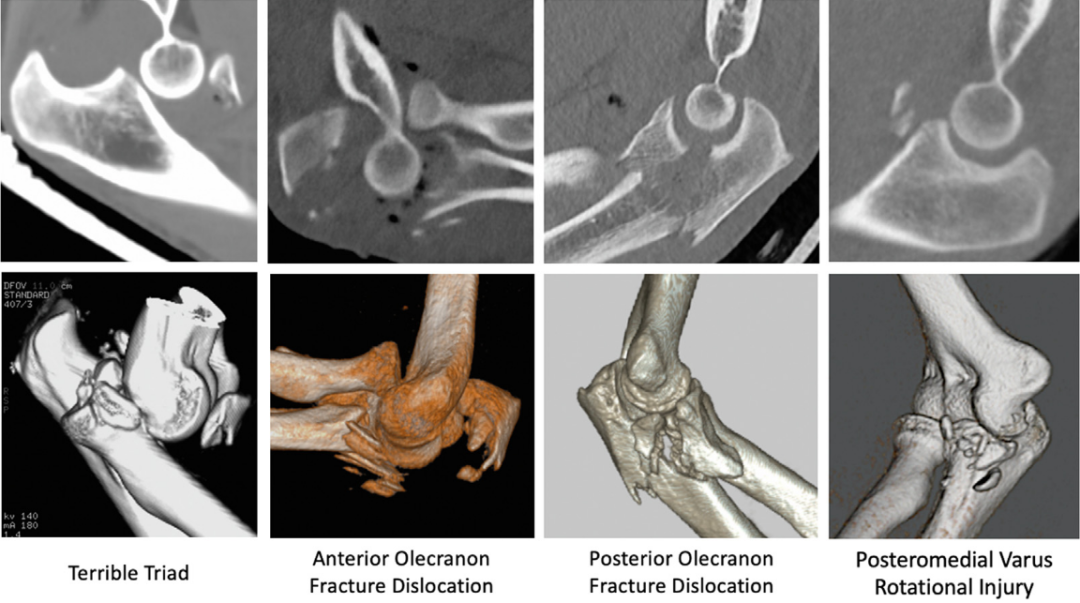冠突骨折的解剖特点、分型与6种内侧手术入路