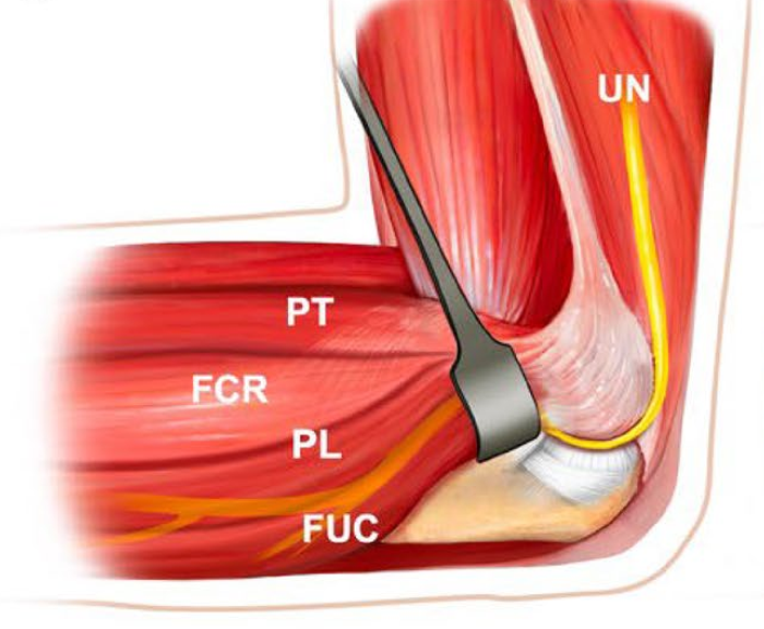冠突骨折的解剖特点、分型与6种内侧手术入路