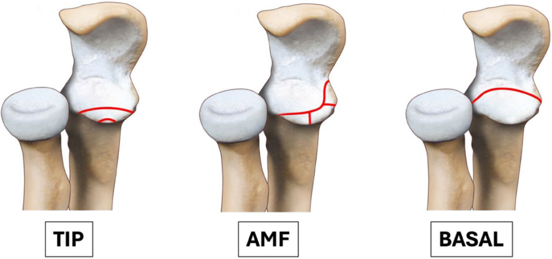 冠突骨折的解剖特点、分型与6种内侧手术入路
