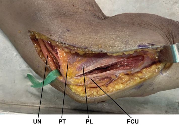 冠突骨折的解剖特点、分型与6种内侧手术入路