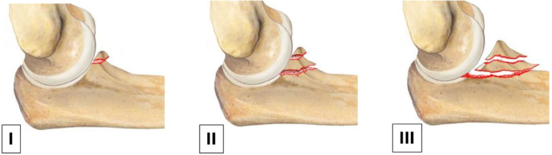冠突骨折的解剖特点、分型与6种内侧手术入路