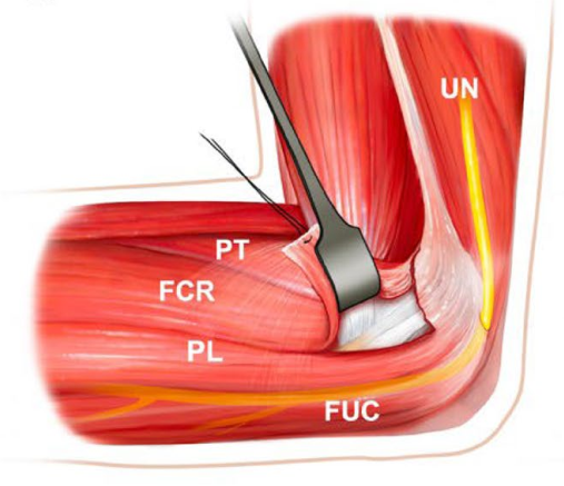 冠突骨折的解剖特点、分型与6种内侧手术入路