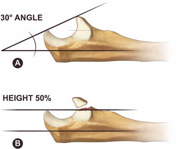 冠突骨折的解剖特点、分型与6种内侧手术入路