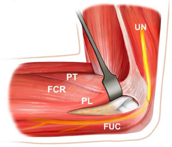 冠突骨折的解剖特点、分型与6种内侧手术入路