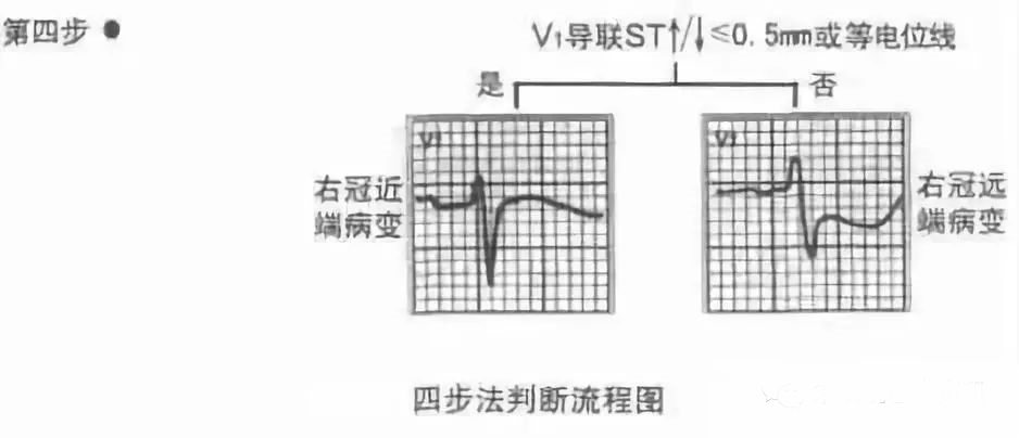 【厉害了】四步法快速定心梗部位和范围