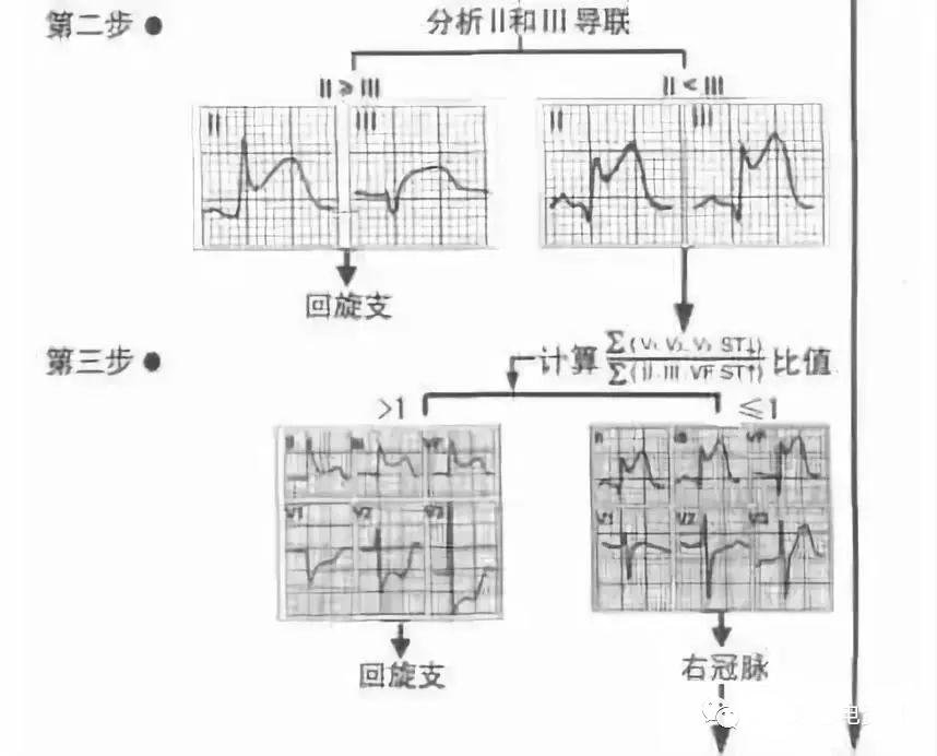 【厉害了】四步法快速定心梗部位和范围