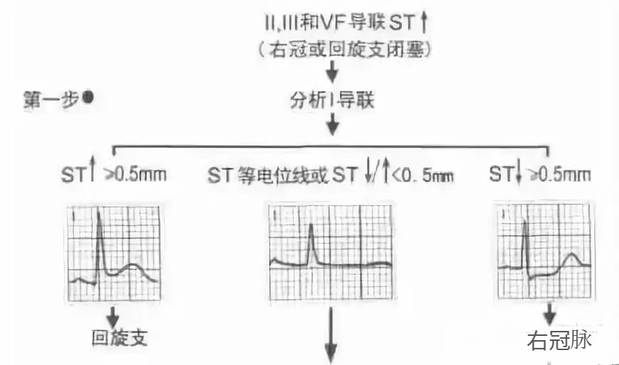 【厉害了】四步法快速定心梗部位和范围