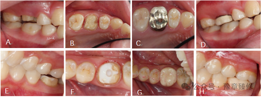 浅谈短冠磨牙的修复策略与方法