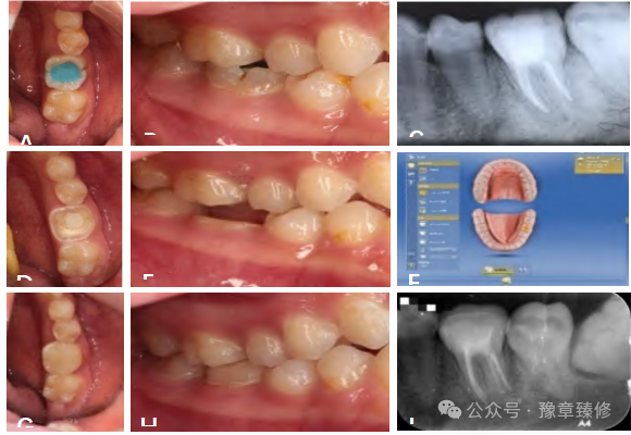 浅谈短冠磨牙的修复策略与方法