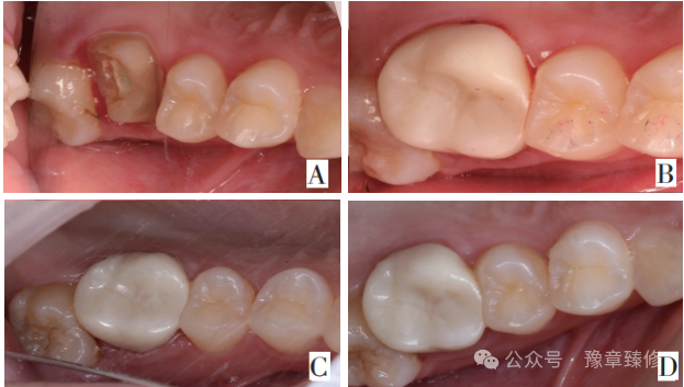 浅谈短冠磨牙的修复策略与方法