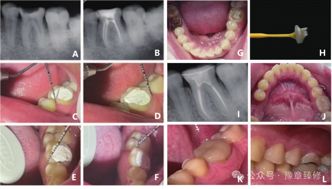 浅谈短冠磨牙的修复策略与方法
