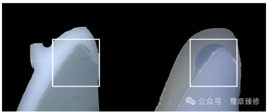 浅谈短冠磨牙的修复策略与方法