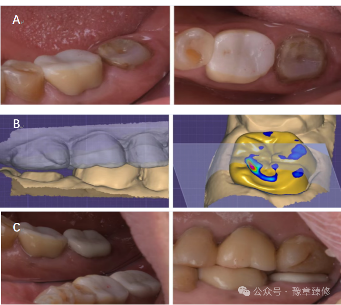 浅谈短冠磨牙的修复策略与方法