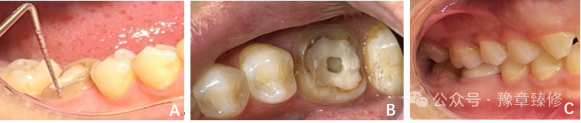 浅谈短冠磨牙的修复策略与方法