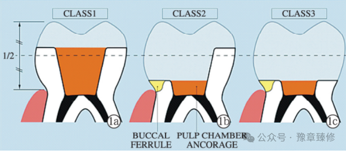 浅谈短冠磨牙的修复策略与方法