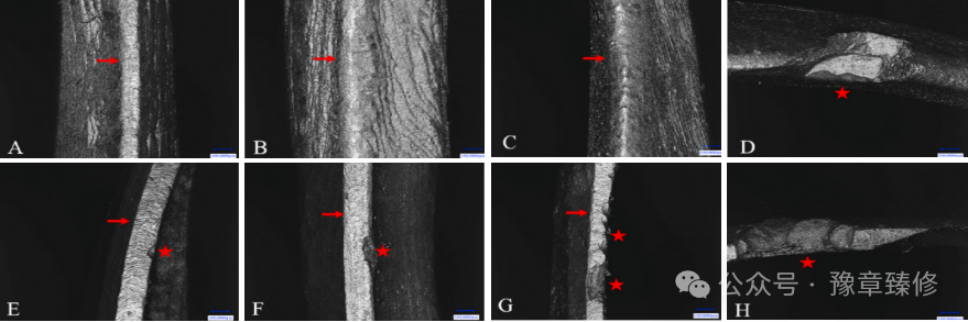浅谈短冠磨牙的修复策略与方法
