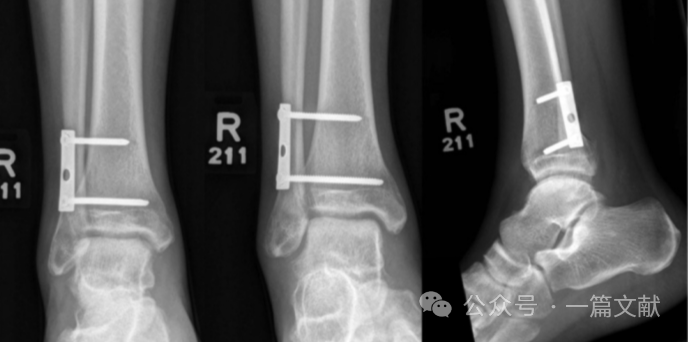 踝关节之下胫腓联合损伤，怎么看？怎么内固定？怎么避坑？