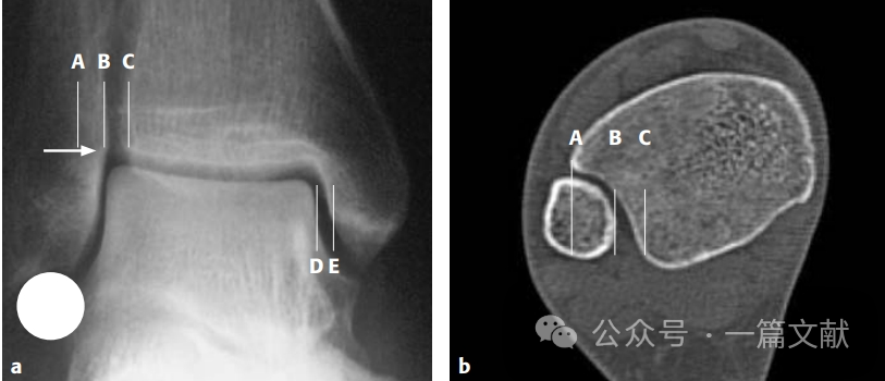 踝关节之下胫腓联合损伤，怎么看？怎么内固定？怎么避坑？