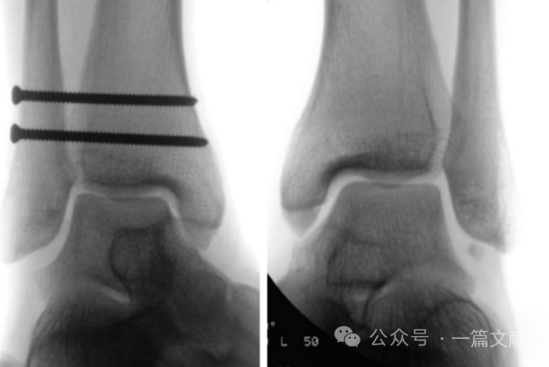 踝关节之下胫腓联合损伤，怎么看？怎么内固定？怎么避坑？