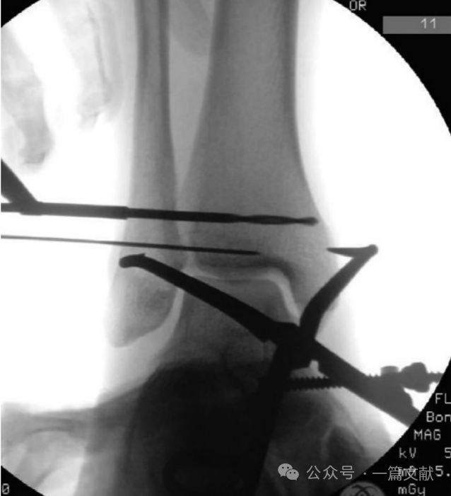 踝关节之下胫腓联合损伤，怎么看？怎么内固定？怎么避坑？