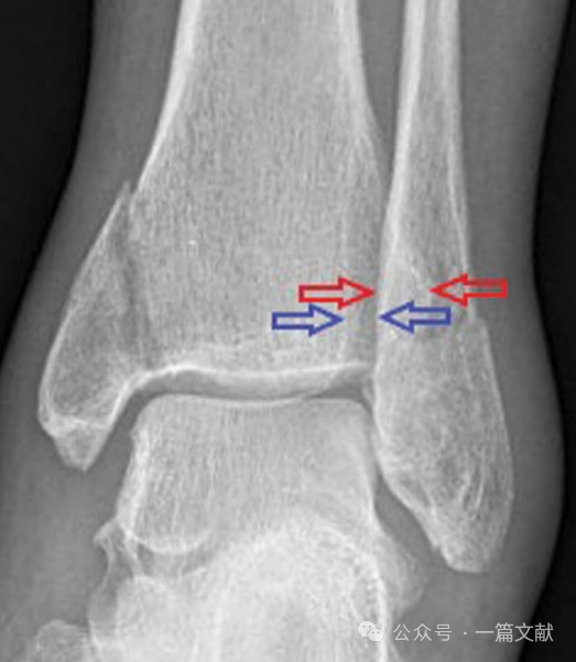 踝关节之下胫腓联合损伤，怎么看？怎么内固定？怎么避坑？