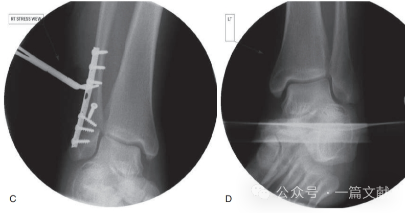 踝关节之下胫腓联合损伤，怎么看？怎么内固定？怎么避坑？