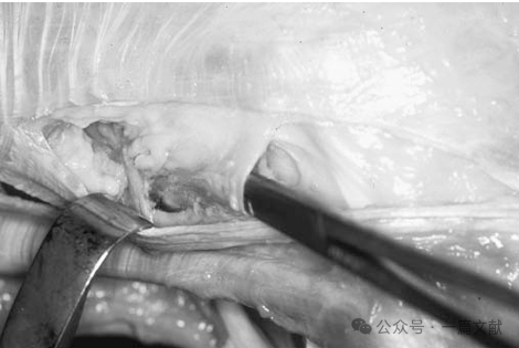 膝关节后外侧复合体