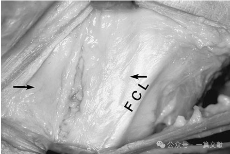 膝关节后外侧复合体