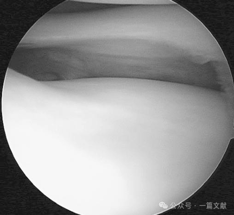 膝关节后外侧复合体