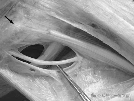 膝关节后外侧复合体