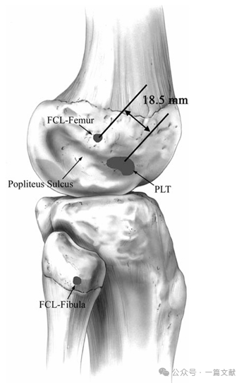 膝关节后外侧复合体