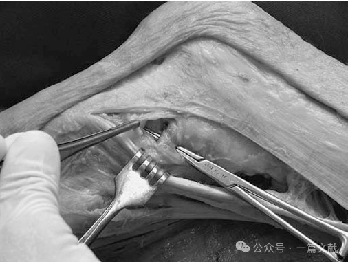 膝关节后外侧复合体