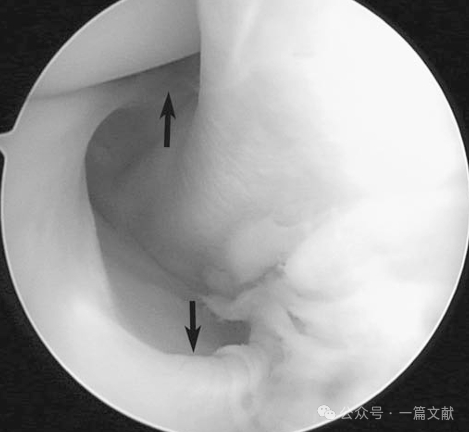 膝关节后外侧复合体