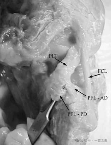 膝关节后外侧复合体