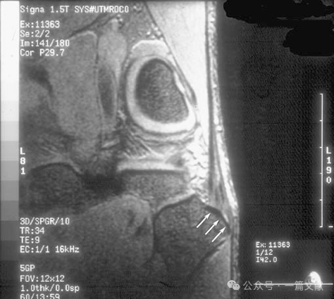 膝关节后外侧复合体