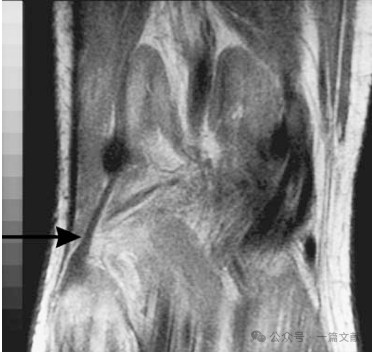 膝关节后外侧复合体