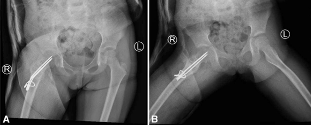儿童股骨颈病理性骨折的治疗策略
