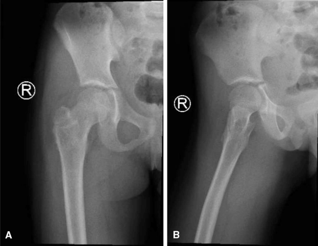 儿童股骨颈病理性骨折的治疗策略