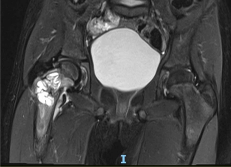 儿童股骨颈病理性骨折的治疗策略