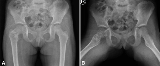 儿童股骨颈病理性骨折的治疗策略