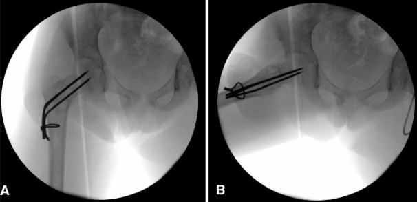 儿童股骨颈病理性骨折的治疗策略