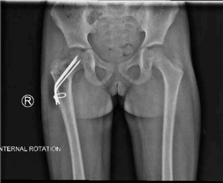 儿童股骨颈病理性骨折的治疗策略