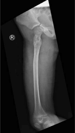 儿童股骨颈病理性骨折的治疗策略