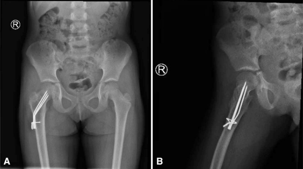 儿童股骨颈病理性骨折的治疗策略