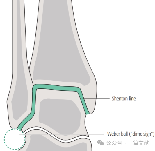踝关节之下胫腓联合损伤，怎么看？怎么内固定？怎么避坑？