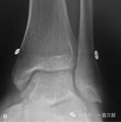 踝关节之下胫腓联合损伤，怎么看？怎么内固定？怎么避坑？