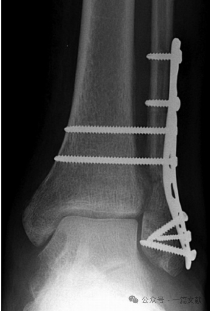 踝关节之下胫腓联合损伤，怎么看？怎么内固定？怎么避坑？
