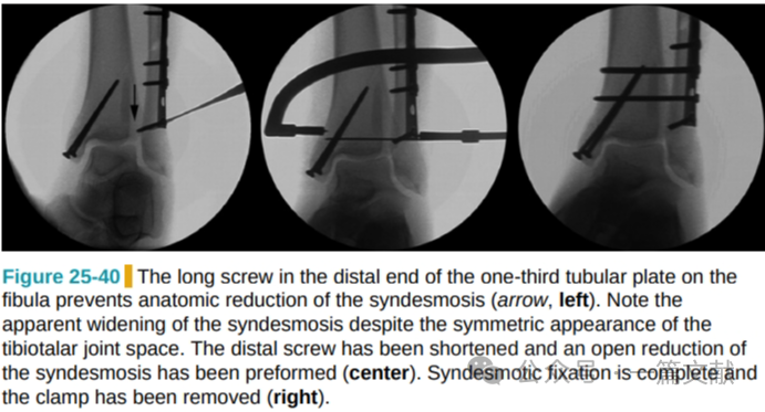 踝关节之下胫腓联合损伤，怎么看？怎么内固定？怎么避坑？