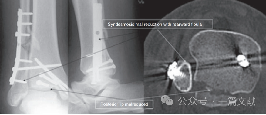 踝关节之下胫腓联合损伤，怎么看？怎么内固定？怎么避坑？